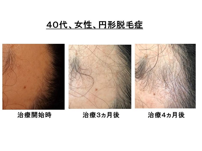 円形脱毛症　病院